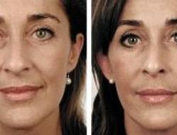 "法令紋" 的英文怎麼說?